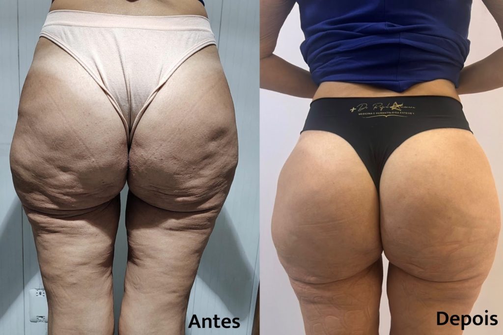 Preenchimento com PMMA corrige volume após emagrecimento